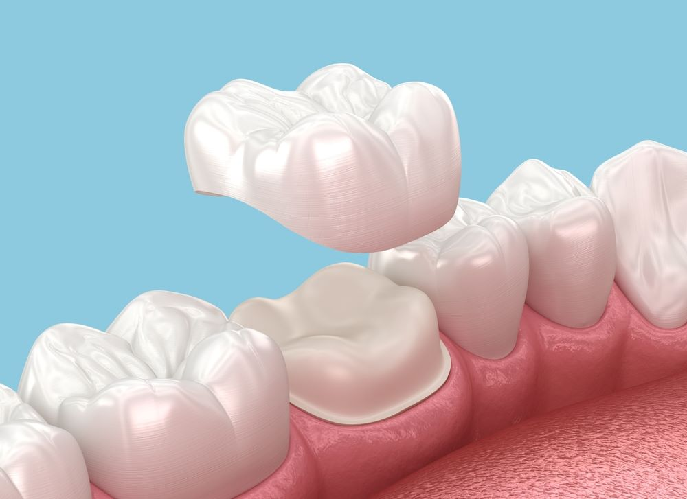 Couronne Dentaire à Casablanca : Restaurer une Dent Abîmée Durablement - Dr Reda Fadil Dentiste Casablanca